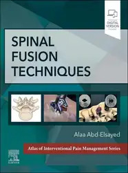 Spinal Fusion Techniques image