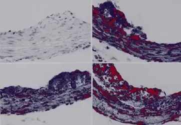 Atherosclerosis: Experimental Methods... image